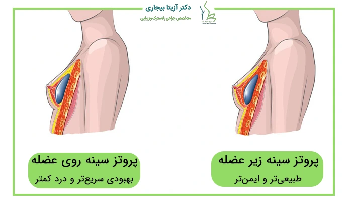 محل گذاشتن پروتز سینه