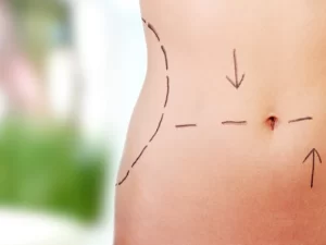 ابدومینوپلاستی