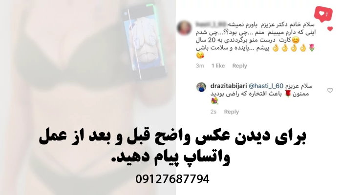 نمونه کار ابدومینوپلاستی