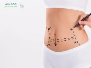 اقدامات قبل از ابدومینوپلاستی