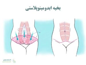 بخیه ابدومینوپلاستی