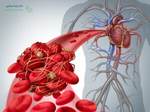 آمبولی بعد از ابدومینوپلاستی
