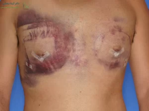 عوارض جراحی ژنیکوماستی چیست؟