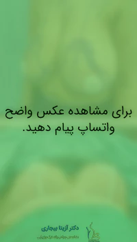 عکس قبل و بعد از ماموپلاستی جراحی