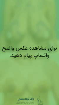 عکس قبل و بعد از ماموپلاستی جراحی