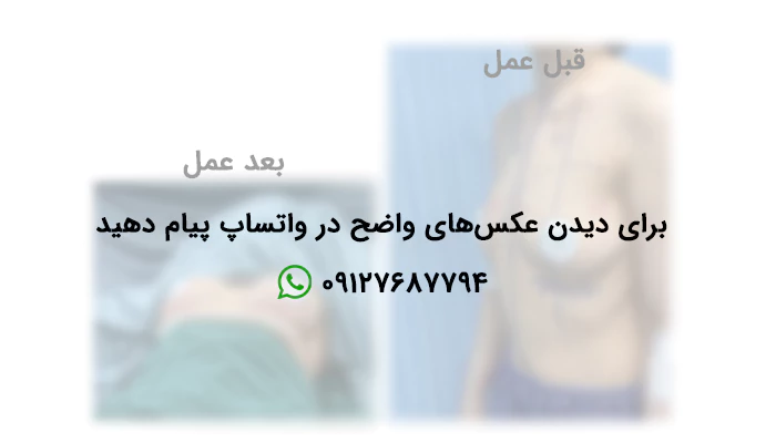 نمونه کار پروتز سینه دکتر بیجاری