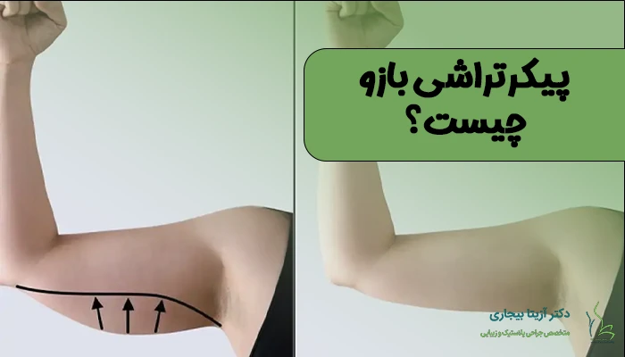 پیکر تراشی بازو چیست