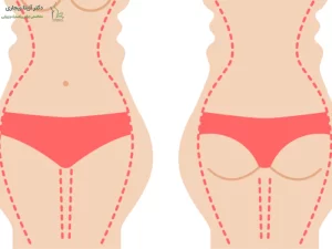 پیکرتراشی پهلو