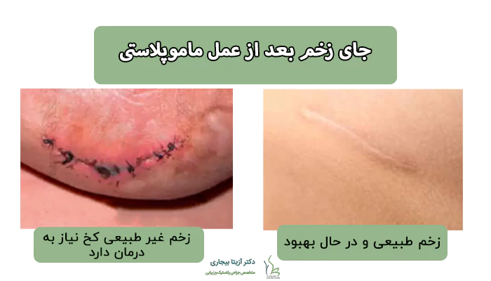 جای زخم بعد از عمل ماموپلاستی