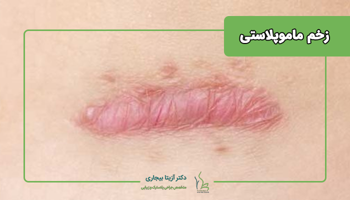 زخم بعد ماموپلاستی