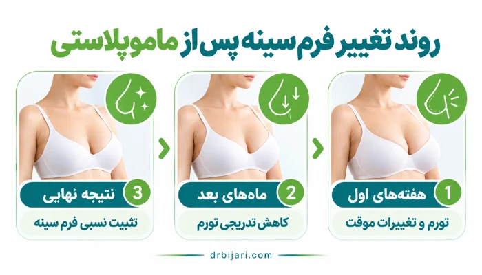روند تغییر فرم سینه بعد از ماموپلاستی از تورم هفتههای اول تا کاهش تدریجی تورم و تثبیت نسبی نتیجه